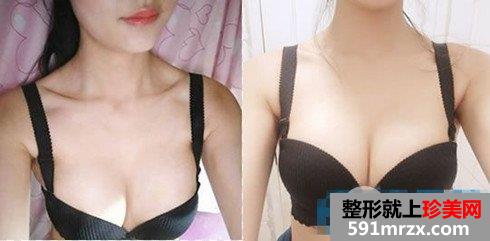王世虎自体脂肪丰胸20天恢复效果