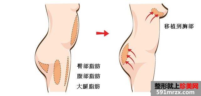 自体脂肪隆胸脂肪抽取填充部位演示图