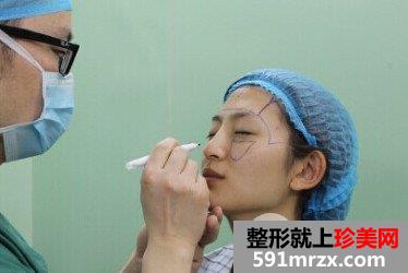 自体脂肪填充全面部前后对比效果照片和恢复过程分享给大家