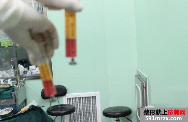 自体脂肪填充全面部前后对比效果照片和恢复过程分享给大家
