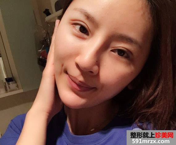 自体脂肪填充全面部前后对比效果照片和恢复过程分享给大家