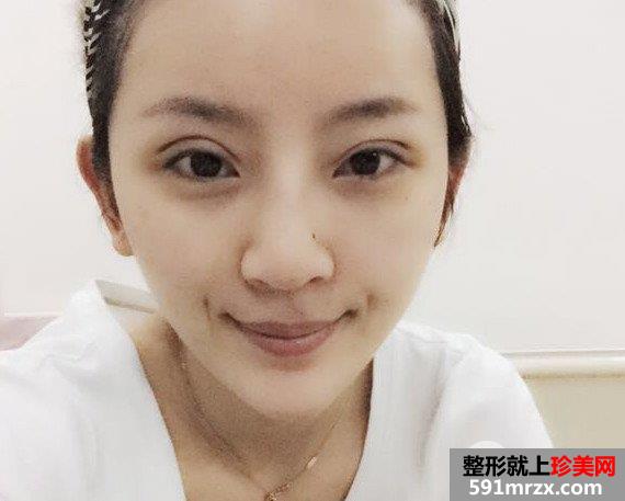 自体脂肪填充全面部前后对比效果照片和恢复过程分享给大家