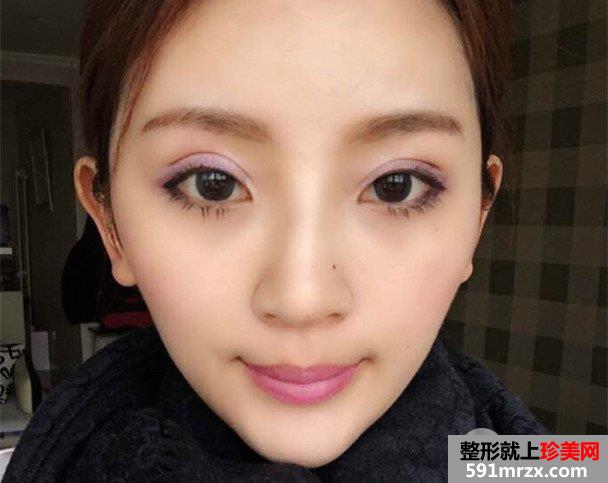 自体脂肪填充全面部前后对比效果照片和恢复过程分享给大家