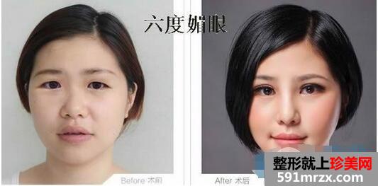 柳州华美兰磊双眼皮案例