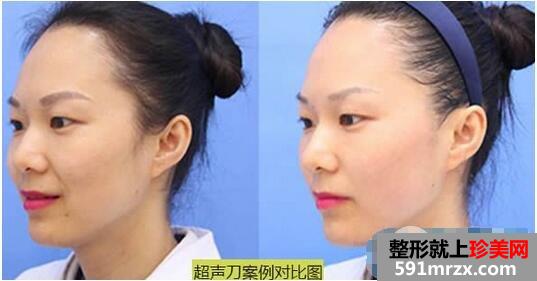 华美刘文先院长超声刀案例图