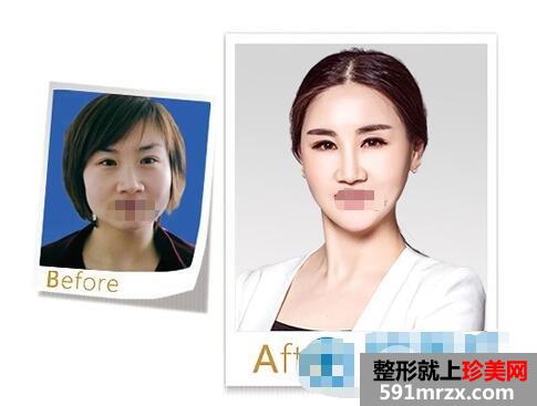 苏州卫康原生态隆鼻、电眼娃娃、V脸案例