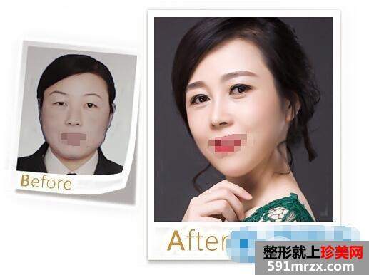 苏州卫康3D无创筋膜紧致术、金手指重睑修复案例