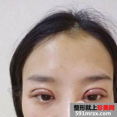 术前照和双眼皮术后第一天效果