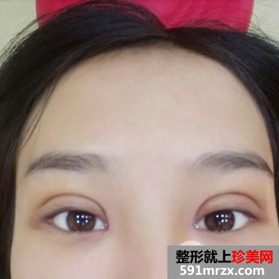 韦敏教授双眼皮术后第二天
