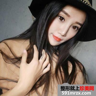 韦敏双眼皮拆线4天恢复情况