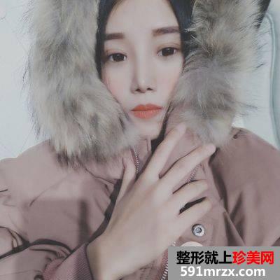 上海九院韦敏双眼皮26天案例图