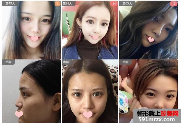 沈阳美联致美管连斌隆鼻案例