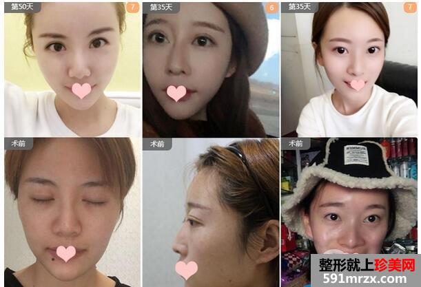 沈阳美联致美管连斌自体脂肪填充哪里