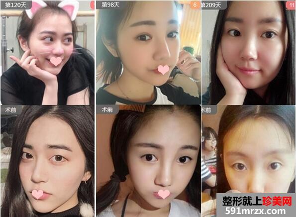 太原美诗沁李东旭双眼皮案例