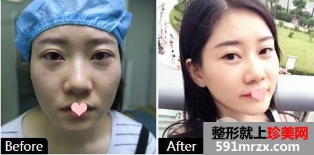 太原美诗沁李东旭祛眼袋案例对比图
