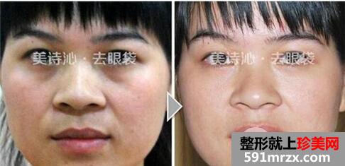 太原美诗沁李永生祛眼袋案例对比图