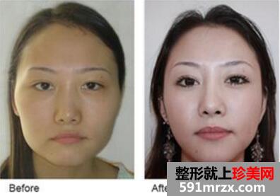 磨颧骨前后对比照片，磨骨价格