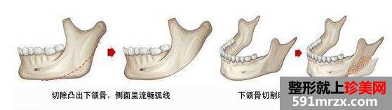 磨下颌骨原理图，磨骨多少钱
