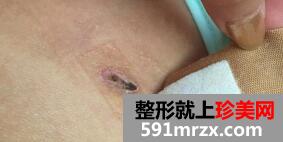 自体脂肪隆胸伤口发炎，真实案例分享