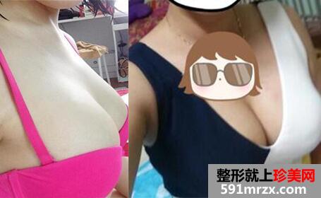 自体脂肪隆胸，吸脂减肥真实案例分享，整形恢复后