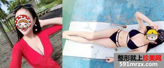自体脂肪填充丰胸手术价格和案例