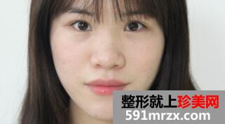 在美莱医院做了鼻综合整形手术价格虽贵但效果好
