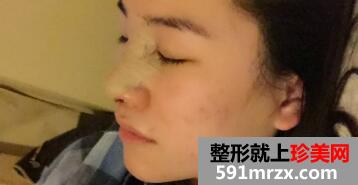 在美莱医院做了鼻综合整形手术价格虽贵但效果好
