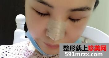 在美莱医院做了鼻综合整形手术价格虽贵但效果好