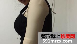 手臂抽脂多少钱?看看我大手臂抽脂的亲身经历吧