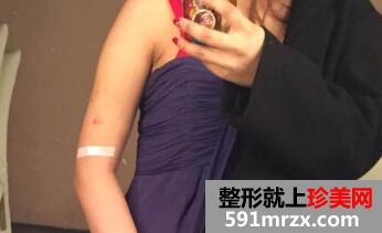 手臂抽脂多少钱?看看我大手臂抽脂的亲身经历吧