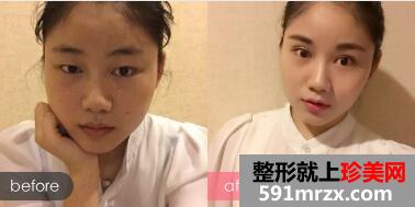 单眼皮变双眼皮真实案例 切开双眼皮15天恢复效果图