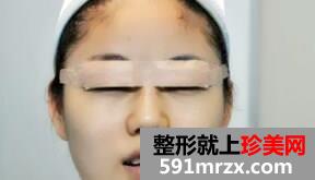 全切双眼皮术后恢复图
