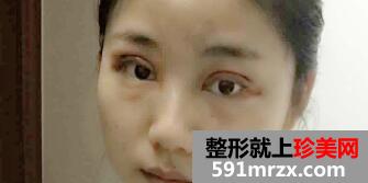 全切双眼皮