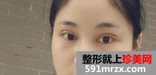 单眼皮变双眼皮真实案例 切开双眼皮15天恢复效果图