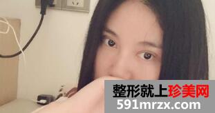 单眼皮变双眼皮真实案例 切开双眼皮15天恢复效果图