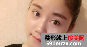 单眼皮变双眼皮真实案例 切开双眼皮15天恢复效果图