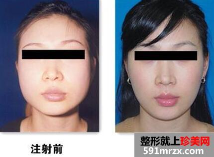 瘦脸前后对比图，瘦脸针的价格曝光
