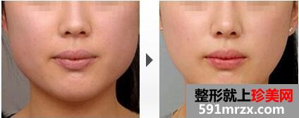 瘦脸前后对比图，瘦脸针的价格曝光