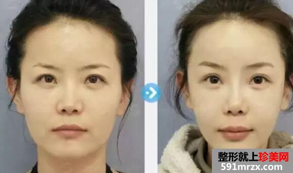 皮肤紧致提升