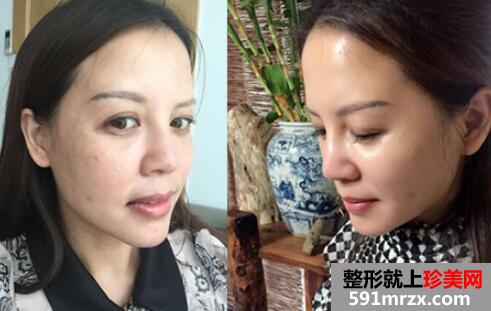 皮肤紧致提升前后对比图，整形价格表曝光