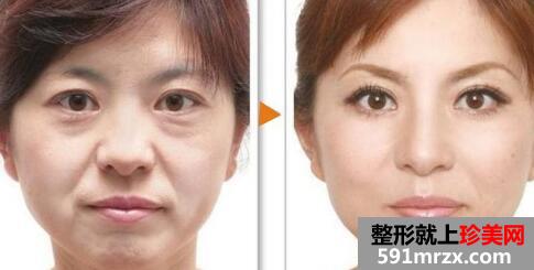 皮肤紧致除皱对比图