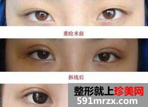 全切双眼皮前后对比图,成都割双眼皮多少钱?最新双眼皮价格介绍