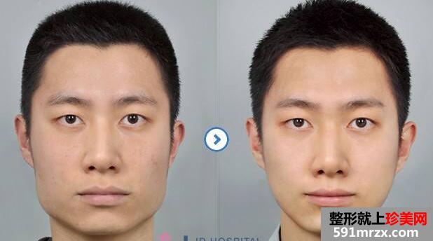 男士磨下颌角整形对比图