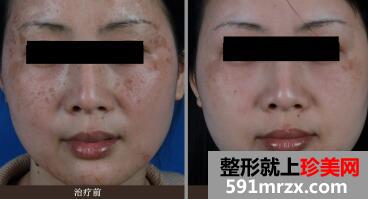 去黄褐斑前后对比图