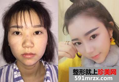 隆鼻前后对比照