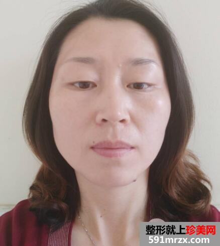 去抬头纹微整形价格不贵效果很好案例分享