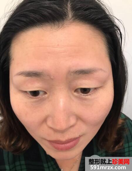 去抬头纹微整形价格不贵效果很好案例分享