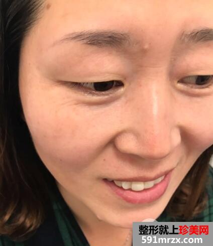 去抬头纹微整形价格不贵效果很好案例分享