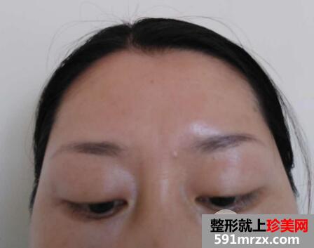 去抬头纹微整形价格不贵效果很好案例分享