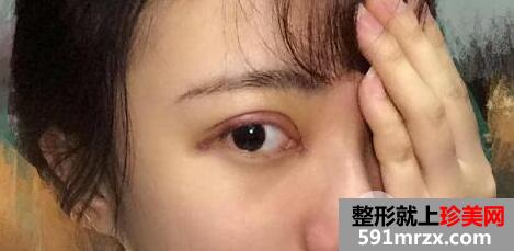 割双眼皮开眼角价格介绍和真人案例分享